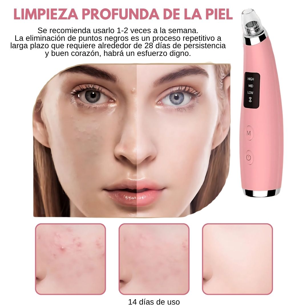 EXTRACTOR DE ESPINILLAS Y PUNTOS NEGROS®