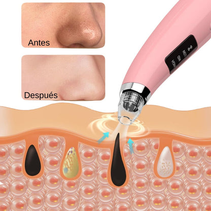 EXTRACTOR DE ESPINILLAS Y PUNTOS NEGROS®